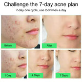 Acne Treatment Face Cream